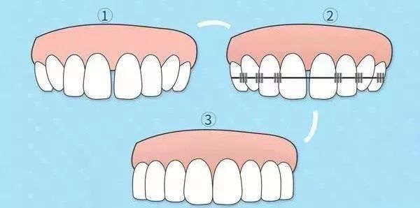 牙齿矫正全流程，做正畸必看！分享给你需要矫正的朋友们