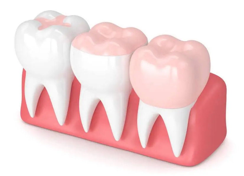 了解嵌体修复，看这篇就够了！