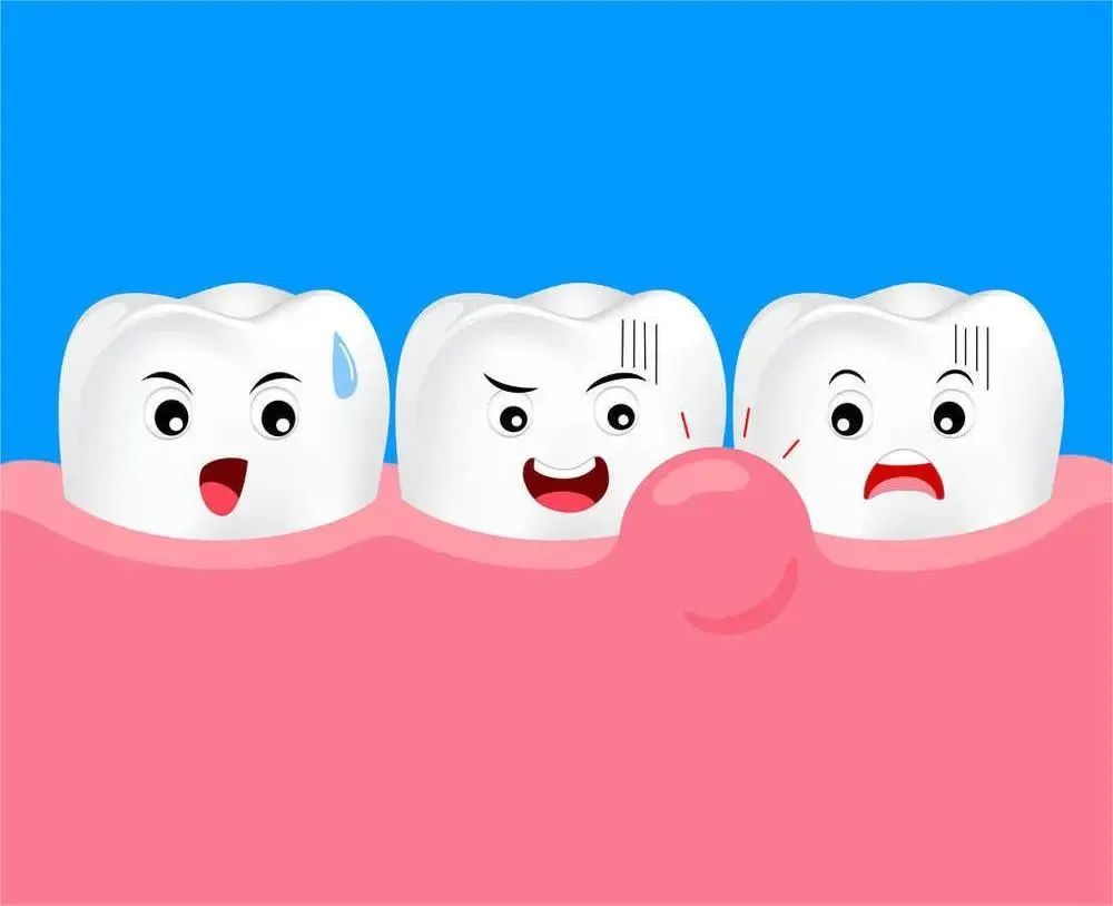 牙龈肿痛不一定是上火，可能是患了根尖周炎