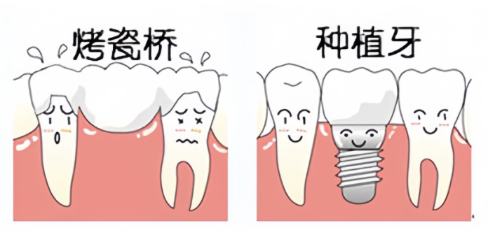 缺牙修复，烤瓷桥好还是种植牙好？