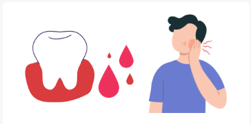 警惕！牙龈出血可能不是上火，而是……